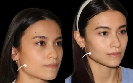 How Long Does Sculptra Fillers Last? Insights from Dubai’s Best Aesthetic Clinic