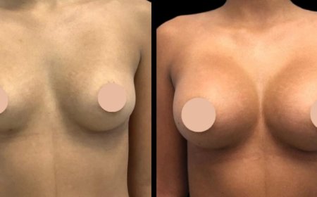 Experience Matters in Breast Augmentation Surgery in Dubai