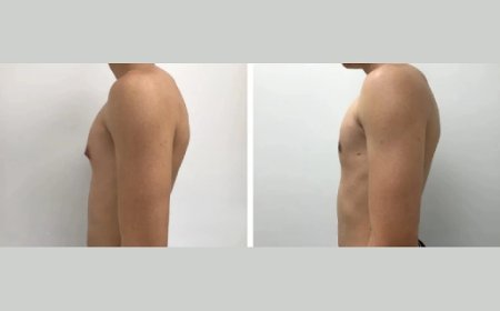 What Is the Best Age for Gynecomastia Surgery in Dubai?