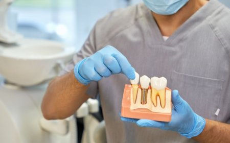 Are Full Mouth Dental Implants Right for You? A Comprehensive Guide