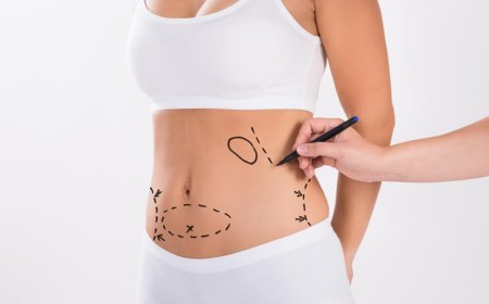 Liposuction for Belly Fat Removal Made Simple and Safe