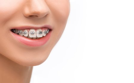 Smile Revolution: Transformative Benefits That Make Damon Braces Worth Considering