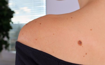 What are the benefits of Birthmarks Removal?