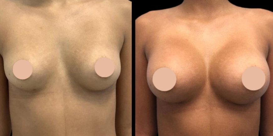 Experience Matters in Breast Augmentation Surgery in Dubai