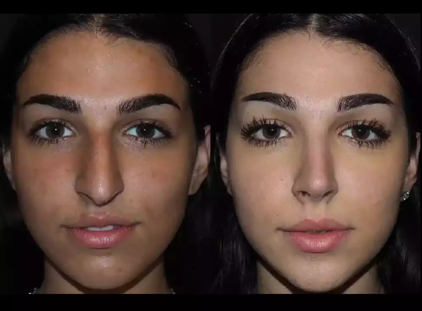 Is Rhinoplasty in Dubai Right for You? A Comprehensive Checklist