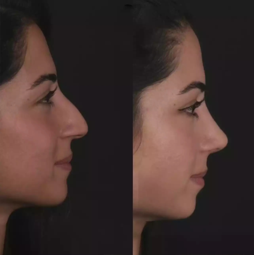Septoplasty in Dubai: From Diagnosis to Results