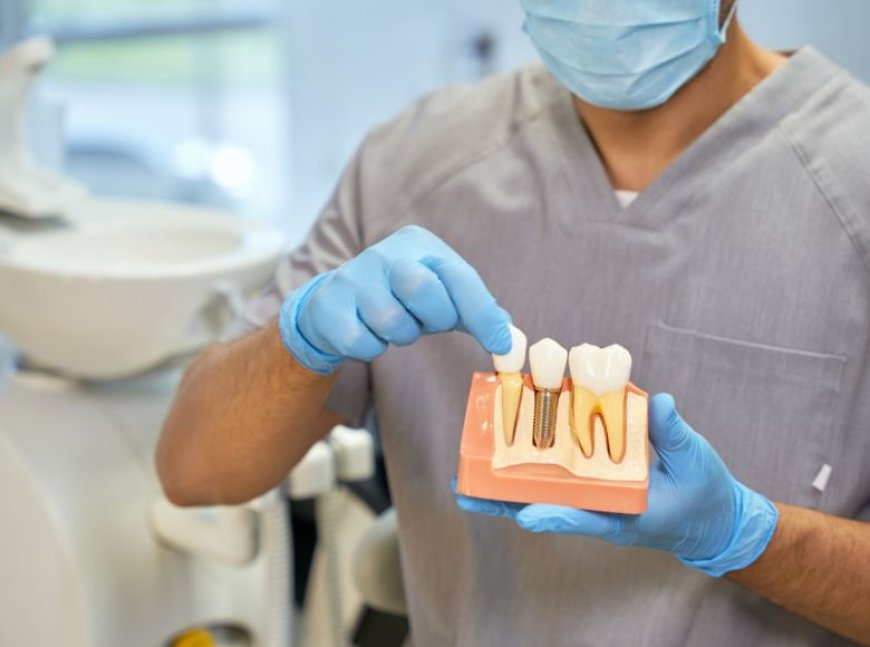 Are Full Mouth Dental Implants Right for You? A Comprehensive Guide