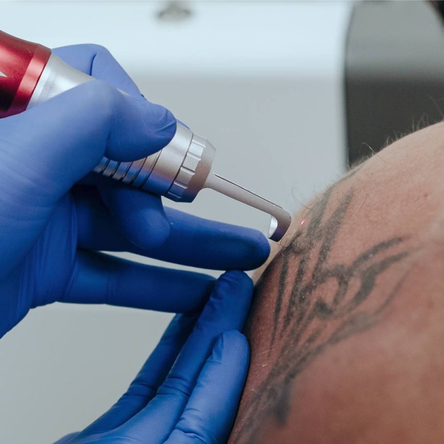 Laser Tattoo Removal Explained with Real Results and Relief