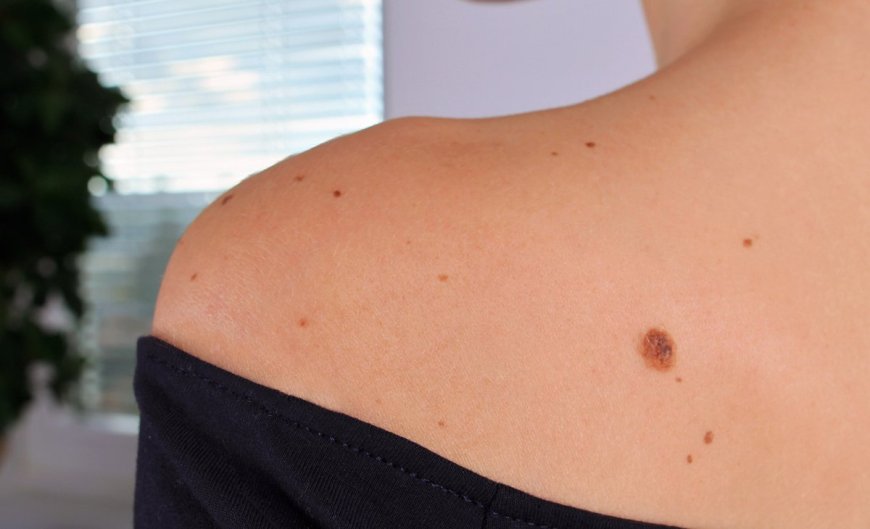 What are the benefits of Birthmarks Removal?