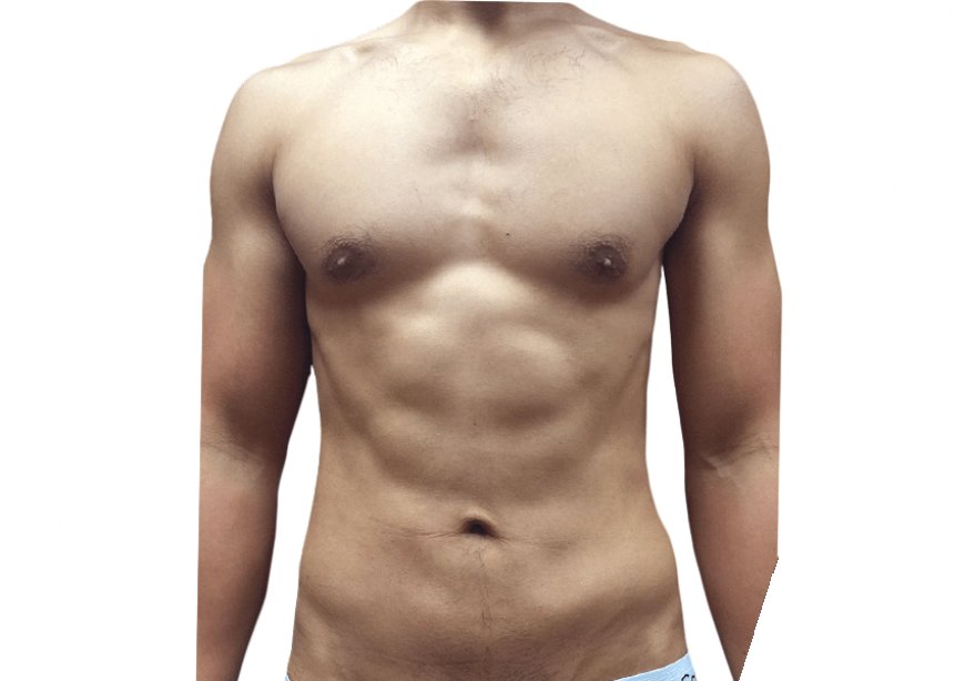 What Makes Vaser 4D Liposuction a Top Body Sculpting Choice