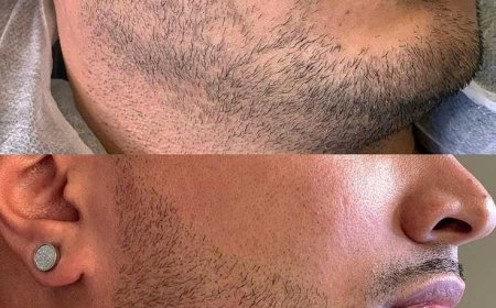 Riyadh & Jeddah Beard Hair Transplant Insights