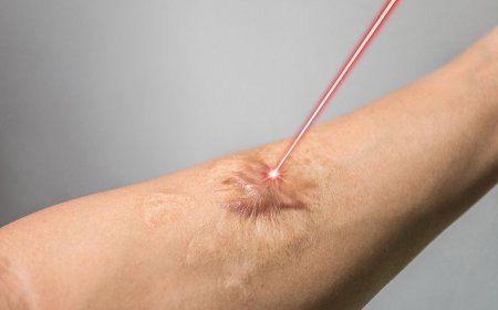 Is Laser Treatment Good for Burn Scars?