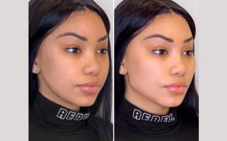 Best Aesthetic Clinics in Dubai Offering Thread Lift for Natural-Looking Results