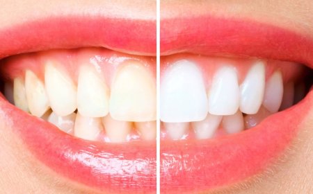 How Teeth Whitening Affects Your Enamel and Oral Health