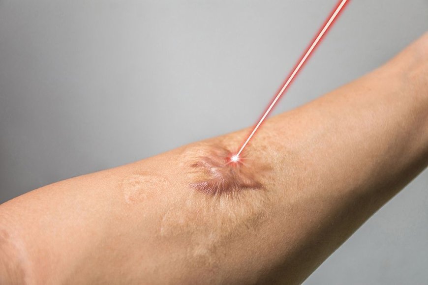 Is Laser Treatment Good for Burn Scars?