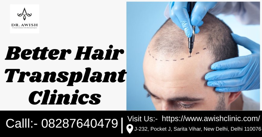 Top 5 Better Hair Transplant Clinics for Natural Results in 2025