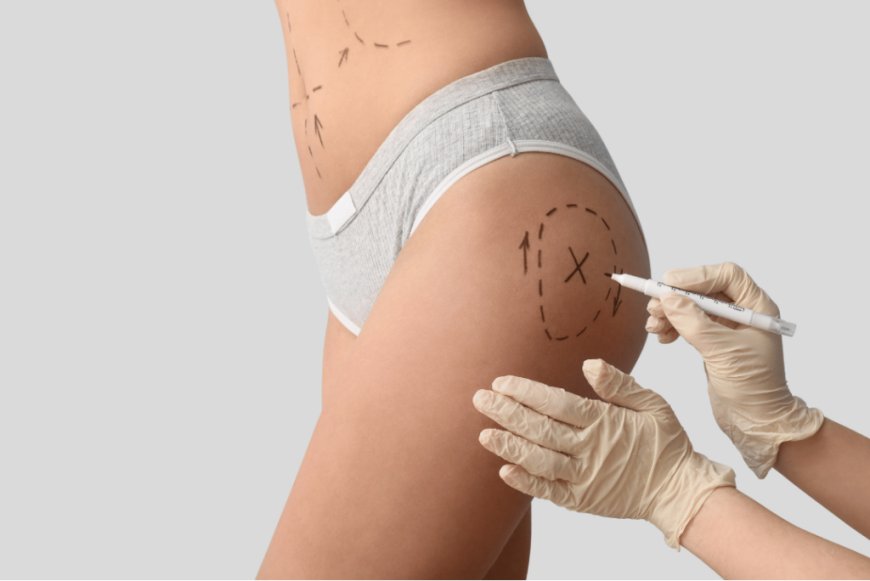 Butt and Body Fillers That Deliver Instant Volume and Definition
