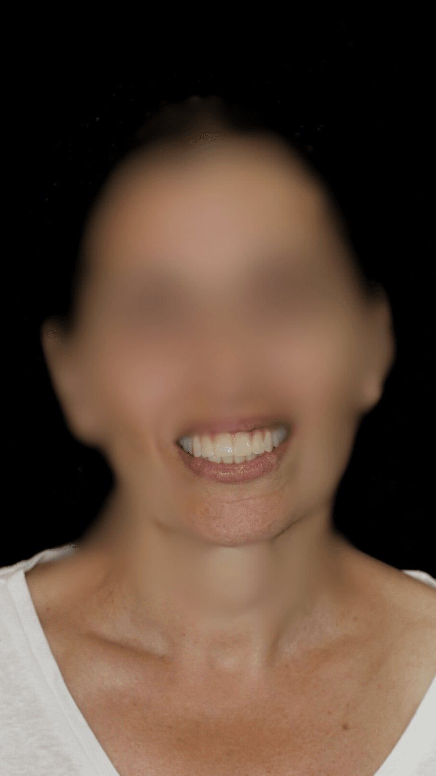 Implantes Dentales en Hospitalet de Llobregat Soluciones Efectivas para tu Sonrisa