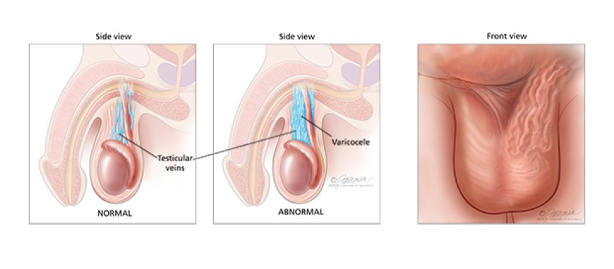 Understanding Testicular Varicocele: Diagnosis and Treatment Options