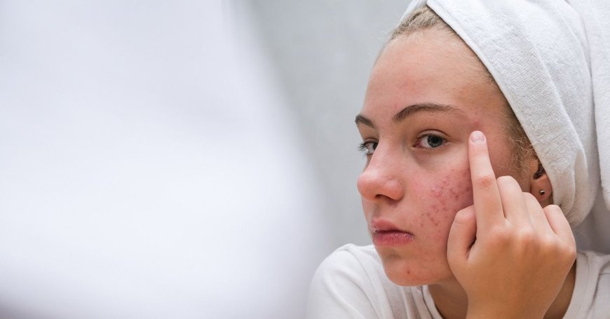 What to Expect From an Acne Treatment That Truly Works